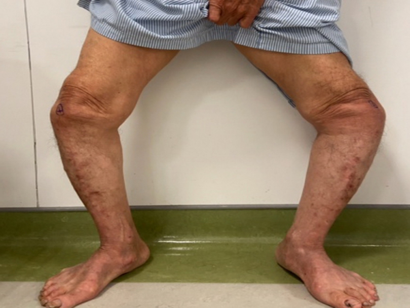 阿公鴨子走路多年  微創膝關節手術解套  還長高5公分