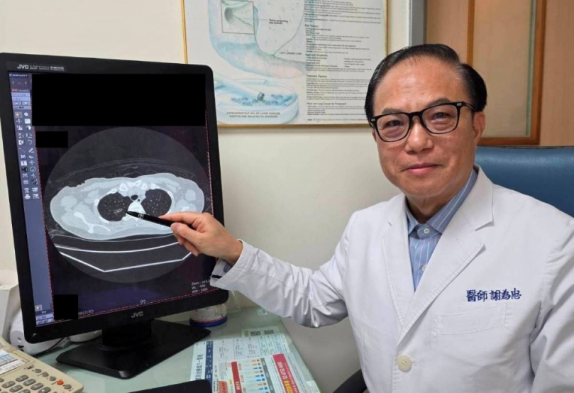 久咳不癒藏危機！ LDCT助主婦揪出早期肺癌 微創手術成功治癒