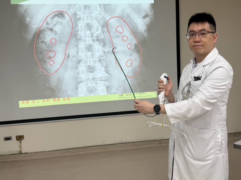 夏季腎結石患者暴增 醫提醒每天至少喝2000cc水防結石