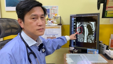 感染﹁類鼻疽菌﹂，員榮醫院副院長涂川洲驗出右肺有兩處膿瘍（紅圈處）。（照片員榮提供）