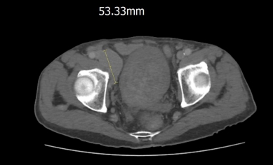 82歲翁腿水腫就醫  驚見罕見雙癌  嘉義醫院羅勖中醫師精準診斷  搶救關鍵黃金期