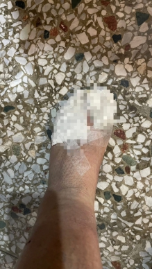 忙救災又ㄧ個重傷|雙腳長期浸泡在泥濘中,光復村長聯誼會長徐振雄,10個腳指頭都磨破快見骨,疑罹患蜂巢性組織炎,病情相當嚴重就醫中!