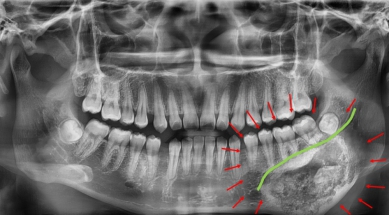 18歲黃女下顎膨脹等症狀,經秀傳醫院檢查罹患罕見「齒源性腫瘤」(牙骨質骨化纖維瘤)。(照片秀傳提供)