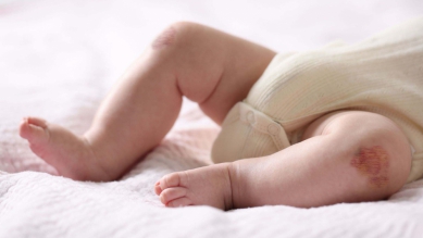 孩子身上出現不明瘀青或關節腫痛  嘉基提醒可能是血友病早期警訊  血液腫瘤科葉芸瑄醫師:規律的預防性治療可以正常生活