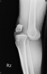 膝關節脫臼合併韌帶斷裂及半月板破裂  仁愛長庚強強聯手重建膝關節